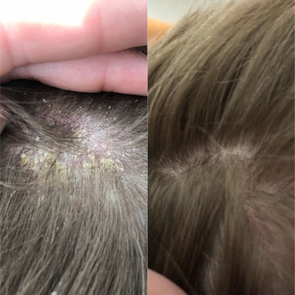 ColdHug - Tratamiento Anticaspa 100% Natural PAGA 1 LLEVA 2