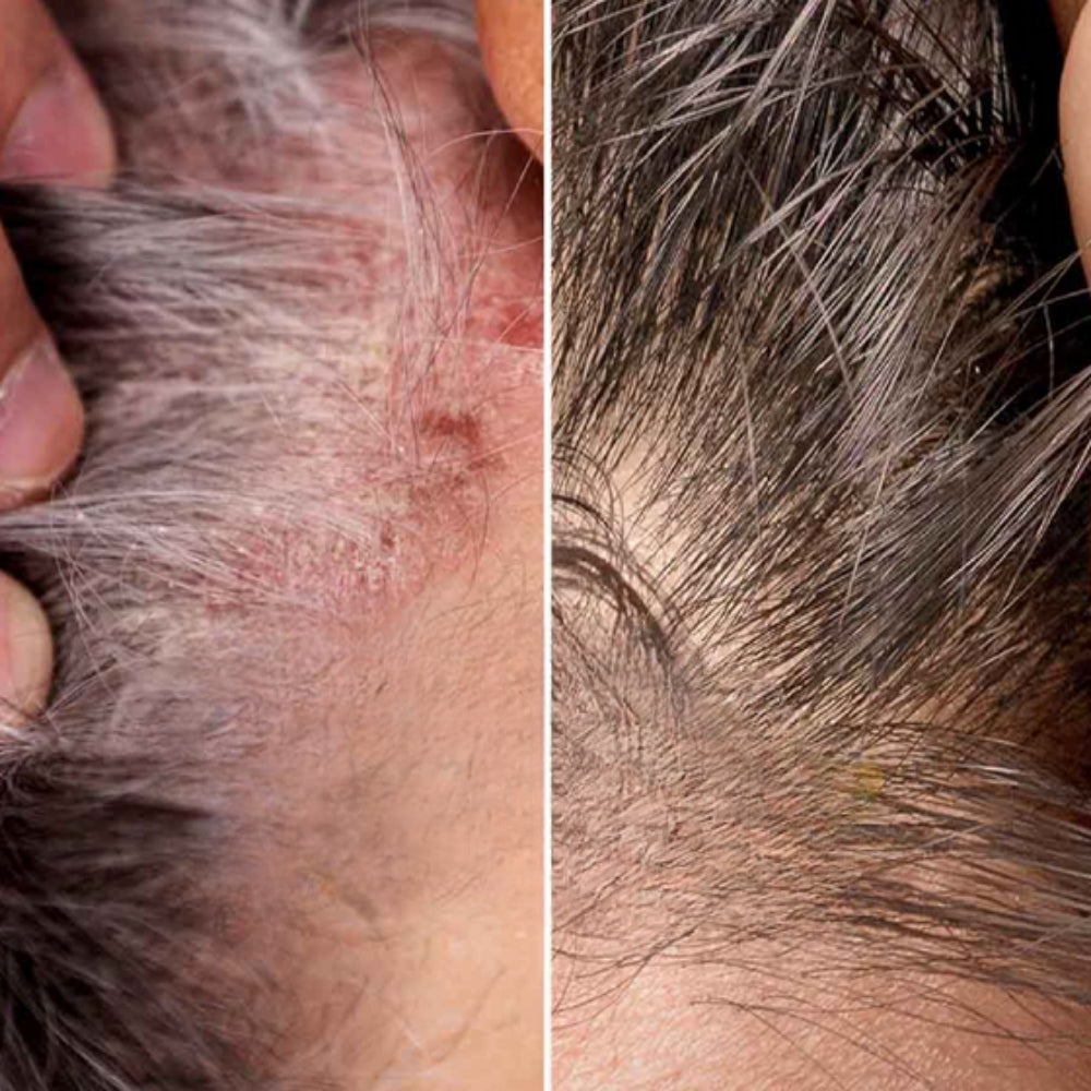 ColdHug - Tratamiento Anticaspa 100% Natural PAGA 1 LLEVA 2