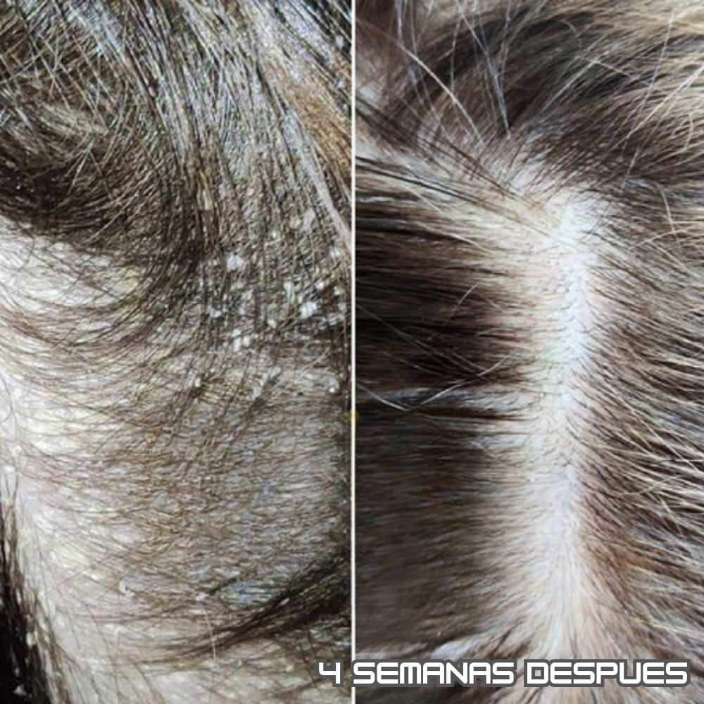 ColdHug - Tratamiento Anticaspa 100% Natural PAGA 1 LLEVA 2